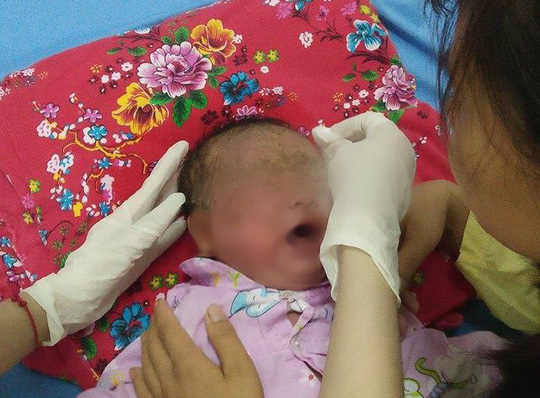 Bé 32 ngày tuổi khắp mặt đóng vẩy xanh vì tắm lá chữa bệnh - 1