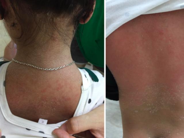 Sức khỏe đời sống - Mắc bệnh lạ, bé gái 3 tuổi ở Phú Thọ bỗng nhiên bong tróc da toàn thân
