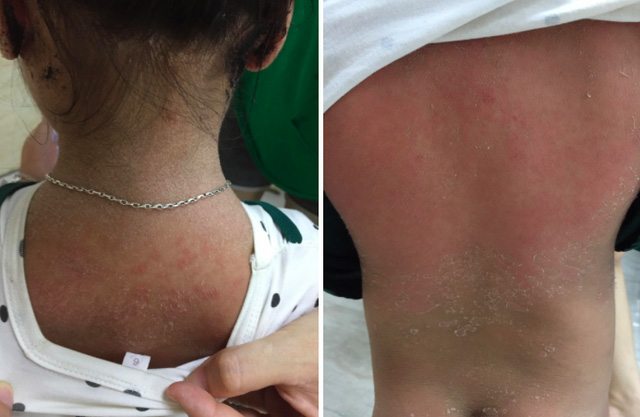 Mắc bệnh lạ, bé gái 3 tuổi ở Phú Thọ bỗng nhiên bong tróc da toàn thân - 1
