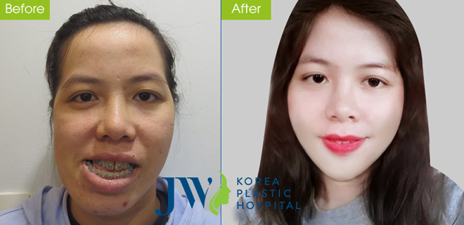 Cô giáo Bình Định có gương mặt méo lột xác ngoạn mục sau phẫu thuật - 3