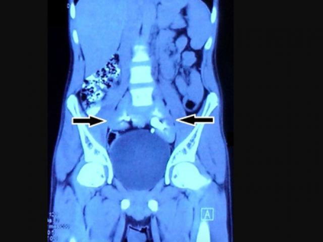 Sức khỏe đời sống - Chụp phim thấy 2 quả thận biến mất, chỉ còn 1… chiếc đĩa!