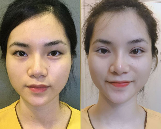 Cắt mí mắt ở đâu cũng giống nhau trừ cắt mí Mani Mini Deep 5D - 3