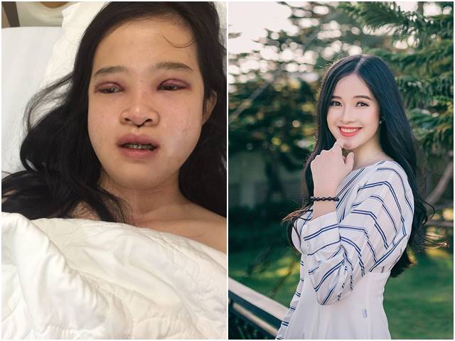 Làm đẹp - Không dám yêu ai vì cằm bồ nông, cô gái Sài Gòn quyết "lột xác" thành mỹ nhân