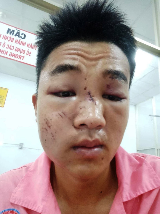 “Va” vào gậy CSGT, một người gãy xương hàm! - 1