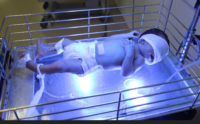 Thay máu cứu sống bệnh nhi 3 ngày tuổi bị vàng da thể nặng - 1