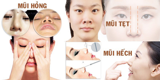 Bác sĩ 2CK1 Ngô Trọng Đức chia sẻ kỹ thuật nâng mũi tái cấu trúc và hiệu quả đạt được từ phương pháp này - 2