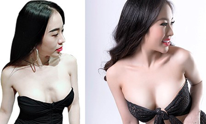 DJ Tuyết Nhung cứu bầu ngực bị lõm sau lần thẩm mỹ thứ 2 - 5