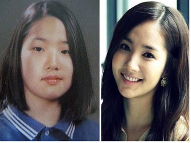 Làm đẹp - Suýt mất mạng, mắt ko thể nhắm vì cắt mí ở cơ sở chui