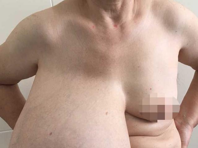 Sức khỏe đời sống - Phát hoảng với ngực khổng lồ, dài đến rốn của một phụ nữ ở Thái Nguyên