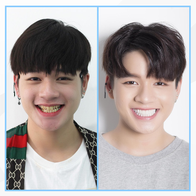 Leo - Zero 9 tiếp nối loạt sao Việt chọn Nha khoa Paris để tìm lại “nụ cười mới” - 4