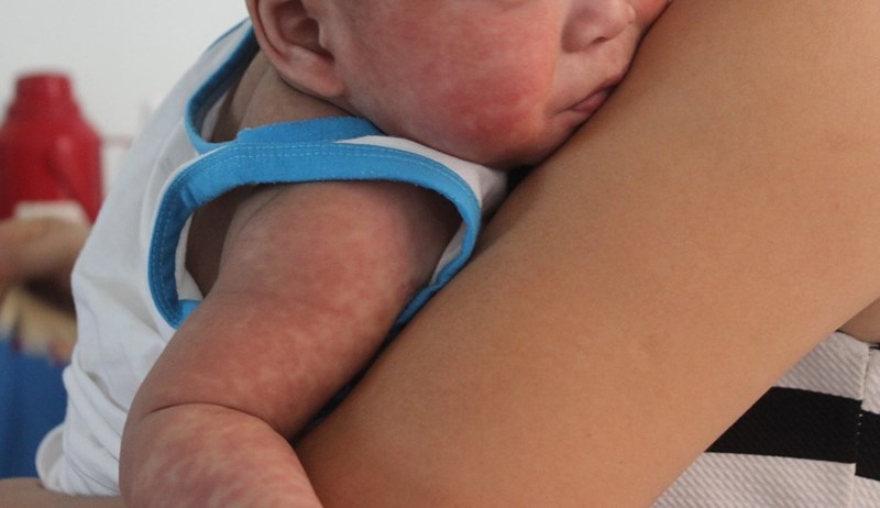 Tất tần tật cách phòng và chăm sóc bệnh sởi - 2