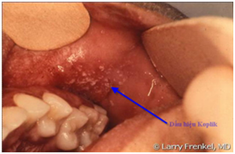 Tất tần tật cách phòng và chăm sóc bệnh sởi - 3