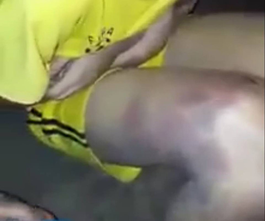 Nam sinh lớp 9 bị bố đánh thâm tím người vì nghi nghiện ma túy - 2