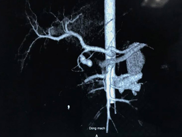 Cứu sống bé 11 tuổi nôn ra máu nhiều lần không tự cầm được - 1