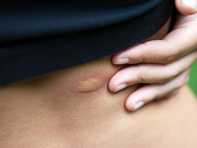 Sức khỏe đời sống - 1 con bọ cắn, người đàn ông suýt chết vì bị "ăn thịt" dần