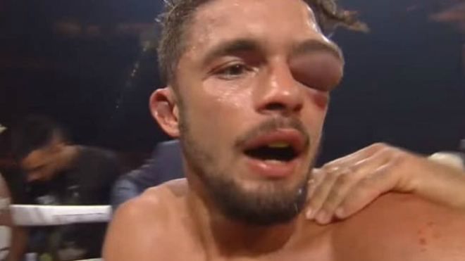 Boxing ác liệt: Kinh hãi võ sỹ mắt sưng to như bóng tennis - 1