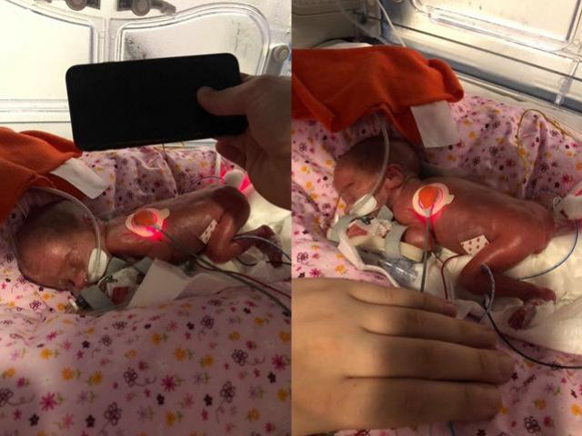 Bạn trẻ - Cuộc sống - Bé gái tí hon nặng vỏn vẹn 0,5 kg, nhỏ hơn cả bàn tay mẹ