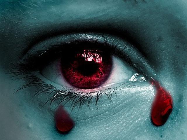 Sức khỏe đời sống - Giọt lệ máu – dấu hiệu bệnh cực hiếm và nguy hiểm
