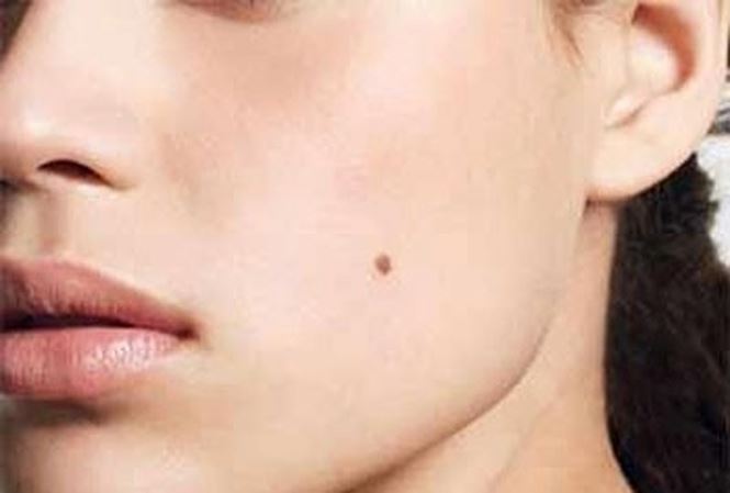 Cực kỳ nguy hiểm khi bị ung thư từ ... nốt ruồi - 1