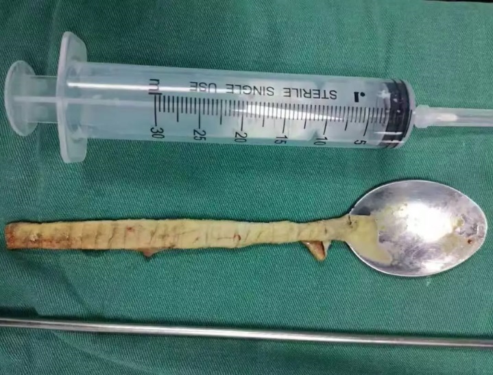 Nuốt thìa dài 20cm vào cổ rồi để kệ đó cả năm vẫn sống bình thường - 2