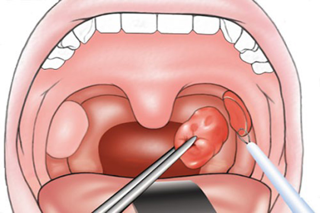 Thủ thuật cắt amidan mãn tính bằng dao Plasma tại Phòng khám Đông Phương - 4