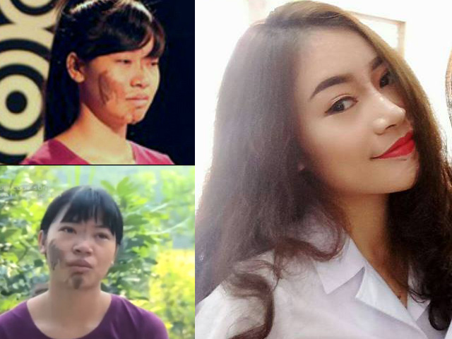 Làm đẹp - Cô gái tộc Sán Dìu tự tin bên bạn trai sau xóa vết đen choán nửa mặt