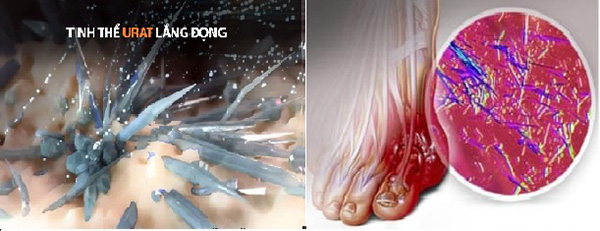 Giảm acid uric, giảm sưng, đau nhức nhờ kiên trì dùng cây này - 2