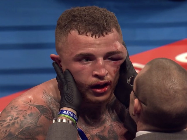 Boxing hãi hùng: Dính cú đấm “sấm sét”, khuôn mặt bị biến dạng