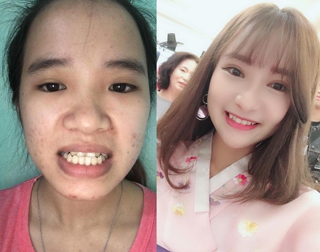 6. Nguyễn Thị Cẩm: Cô gái Quảng Nam 20 tuổi này gặp nhiều khó khăn trong ăn uống, sinh hoạt và cuộc sống chỉ vì hàm răng cắn ngược.&nbsp;