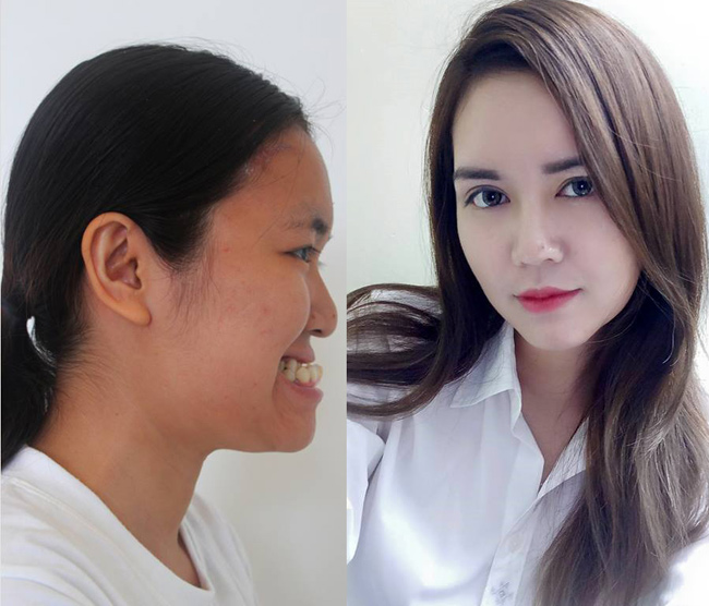Tuy nhiên, sau đó, Lê Huyền Trang đã thay đổi hoàn toàn nhơ làm mũi S-line, cằm Vline, nhấn mí, làm trắng da và chỉnh hàm.