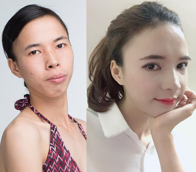 8. Bùi Thị Dịu: Nữ sinh Bắc Giang từng bị chê bai nhan sắc đã trở nên xinh đẹp sau khi chỉnh hàm, nhấn mí, thu nhỏ cánh mũi, bọc răng sứ...&nbsp;