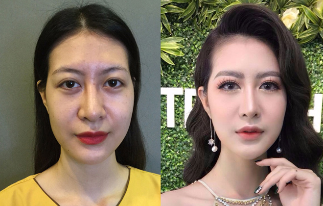 Tràn lan cắt mí Mini Deep trên thị trường, đâu mới là chuẩn? - 4