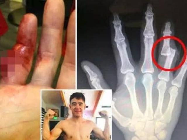 Phi thường MMA: Võ sỹ gãy ngón tay vẫn cắn răng ”quyết tử” đến cùng
