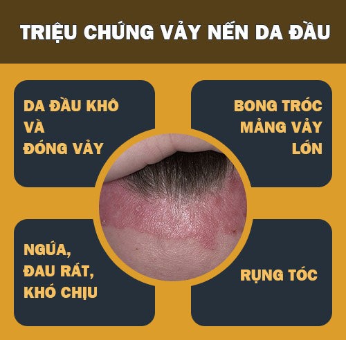 Vảy nến da đầu: Hiểu rõ để điều trị bệnh hiệu quả - 1