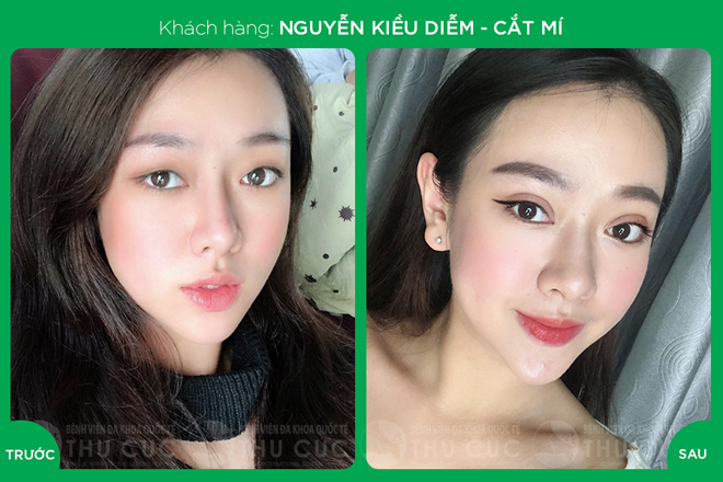 HOT: Bệnh viện đa khoa quốc tế Thu Cúc tặng 40 suất phẫu thuật thẩm mỹ miễn phí - 3