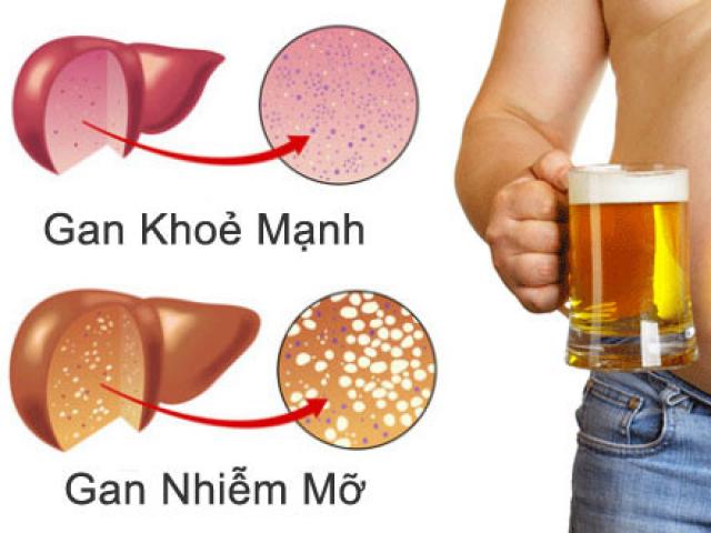 Sức khỏe đời sống - Rượu phá huỷ gan như thế nào?