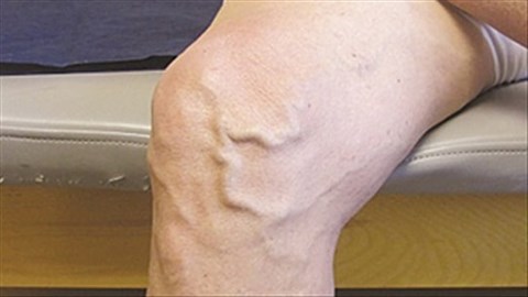 Chân ngứa ngứa, có đường gân cần tới bệnh viện kiểm tra ngay - 1