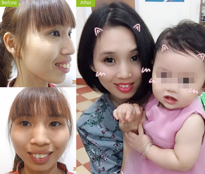 5 thầy cô giáo tự tin theo nghề sau phẫu thuật thẩm mỹ - 2