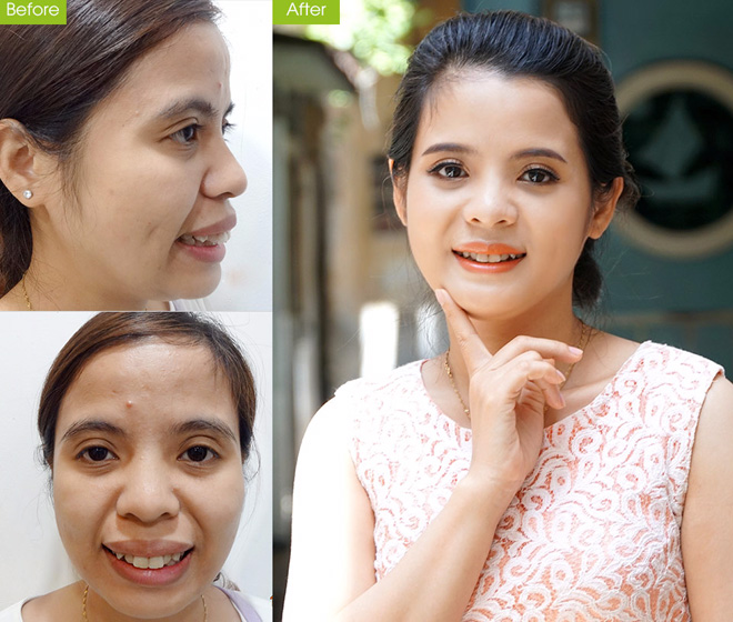 5 thầy cô giáo tự tin theo nghề sau phẫu thuật thẩm mỹ - 4