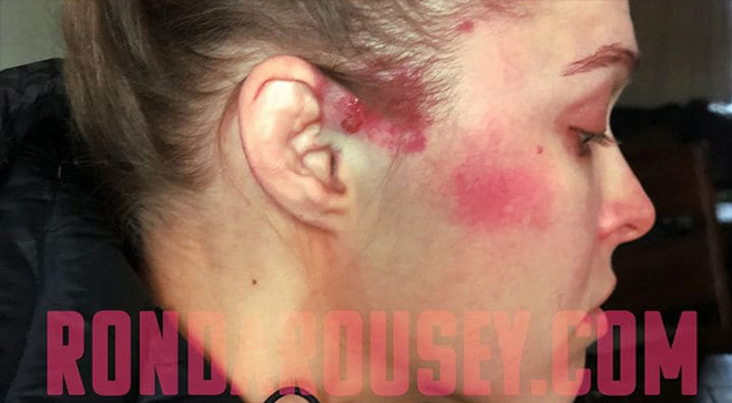 &#34;Nữ hoàng UFC&#34; Rousey đụng phải &#34;quái nữ&#34;: Bị đánh vỡ mày vỡ mặt - 1