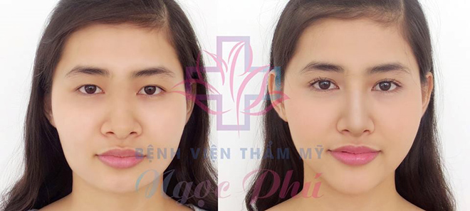 Bệnh viện Thẩm mỹ Ngọc Phú cập nhật nhiều dịch vụ làm đẹp mới đến từ Hàn Quốc - 2