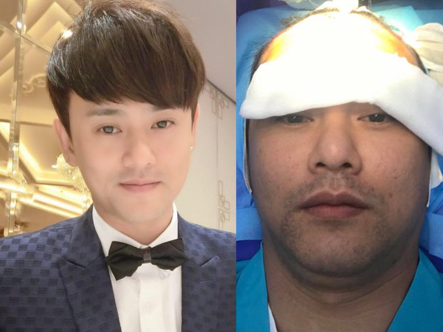 Đời sống Showbiz - Lộ đầu hói trên sóng quốc gia, Ưng Đại Vệ quyết định cấy 2000 sợi tóc