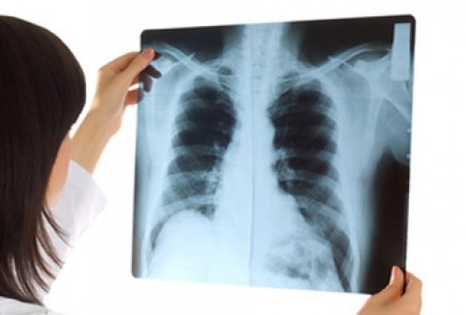 Dấu hiệu sớm căn bệnh &#39;sát thủ&#39; 21.000 người chết mỗi năm - 2