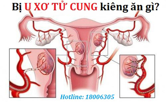 Người bị u xơ tử cung kiêng ăn gì và nên ăn gì? - 1