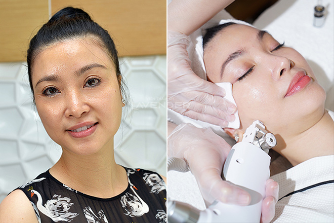 Vừa cập bến Việt Nam, trẻ hóa da Thermage FLX đã tạo nên cơn sốt với phái đẹp - 11