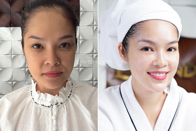 Vừa cập bến Việt Nam, trẻ hóa da Thermage FLX đã tạo nên cơn sốt với phái đẹp - 6