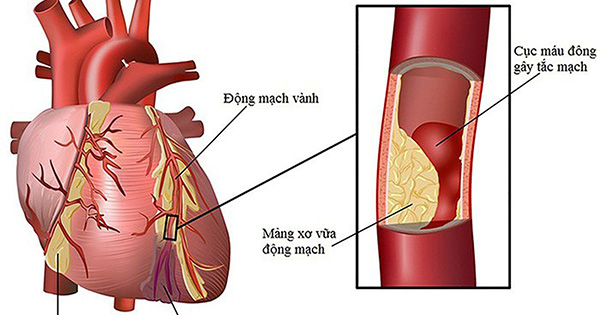 Người huyết áp cao mà đau đầu, chóng mặt sẽ hối hận vì không biết cách này sớm - 2