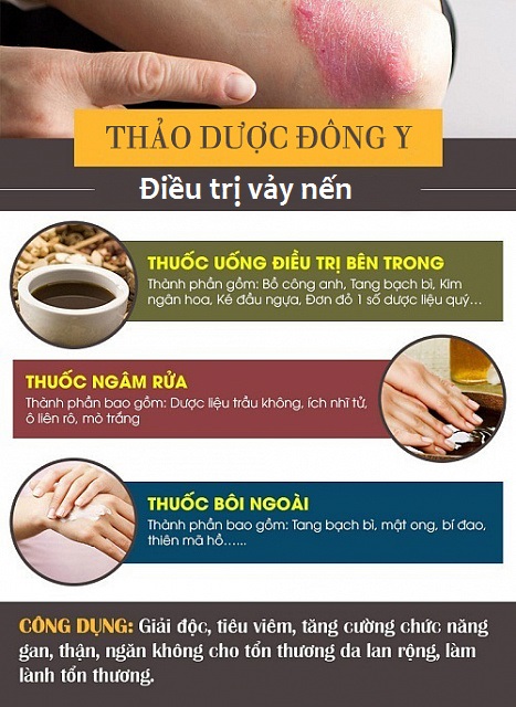 Bệnh vảy nến khổ và khó chịu, điều trị bằng cách nào hữu hiệu nhất? - 3