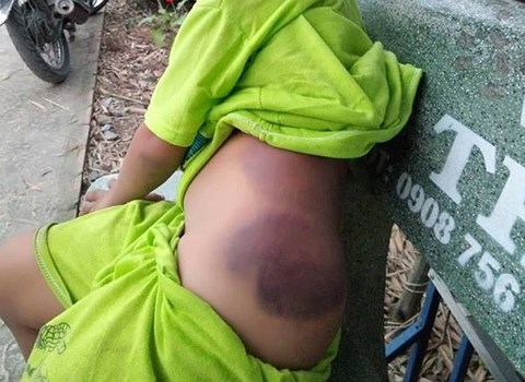 Bé trai lớp 1 khuyết tật nghi bị cô giáo đánh bầm tím người - 1
