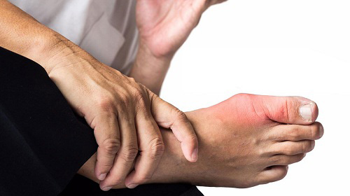 Sưng, đau nhức ngón chân cái: Đừng nhầm Gút với bệnh khớp - 1